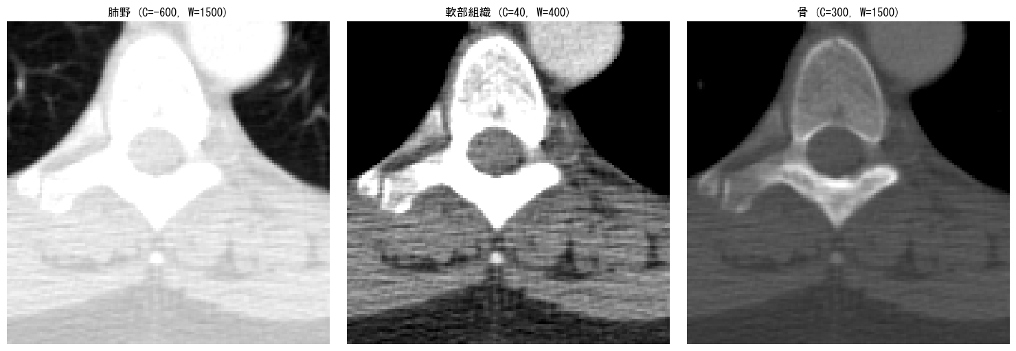 肺野・軟部組織・骨の3種類のウィンドニングを適用したCT画像の比較